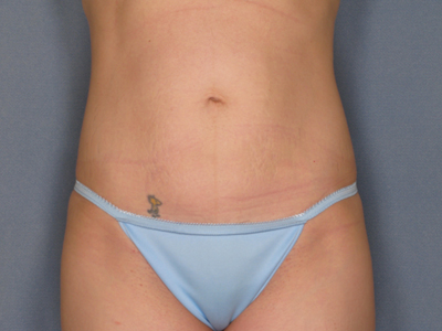 Tummy Tuck Before & After Patient #1623