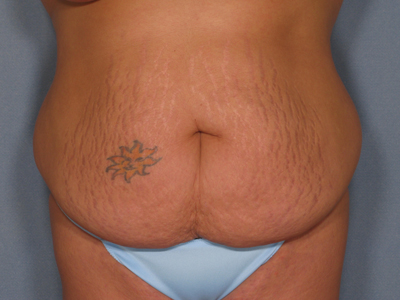 Tummy Tuck Before & After Patient #1638