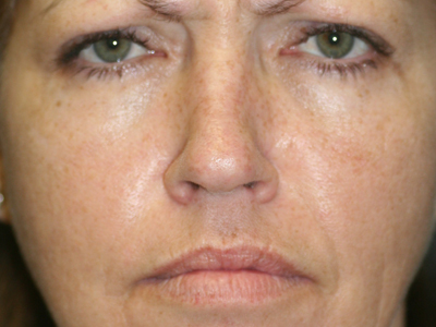 Dysport/Botox Before & After Patient #1642