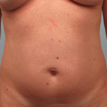 Tummy Tuck Before & After Patient #1299