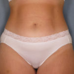 Tummy Tuck Before & After Patient #1651
