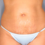 Tummy Tuck Before & After Patient #1669