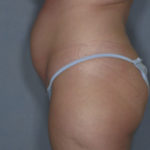 Tummy Tuck Before & After Patient #1683