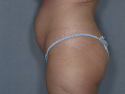 Tummy Tuck Before & After Patient #1683