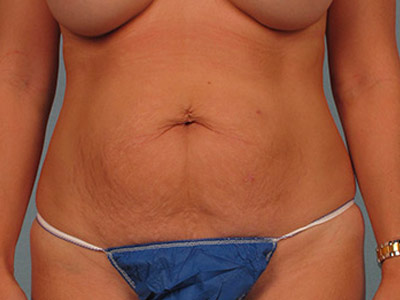 Tummy Tuck Before & After Patient #1693