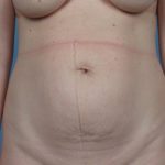 Tummy Tuck Before & After Patient #1310