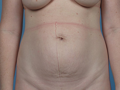 Tummy Tuck Before & After Patient #1310