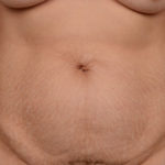 Tummy Tuck Before & After Patient #1811