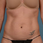 Tummy Tuck Before & After Patient #1853