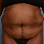 Tummy Tuck Before & After Patient #1937