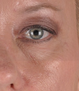 Eyelid Surgery Before & After Patient #2044