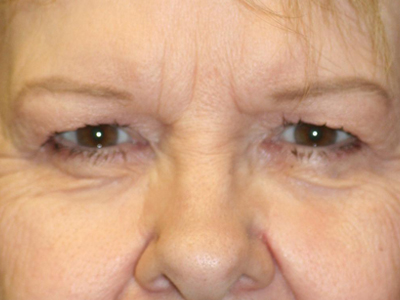 Eyelid Surgery Before & After Patient #2137