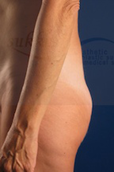 Brazilian Butt Lift Before & After Patient #627