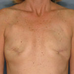 Breast Reconstruction Before & After Patient #3400