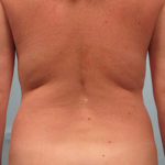 Vaser Liposuction Before & After Patient #770