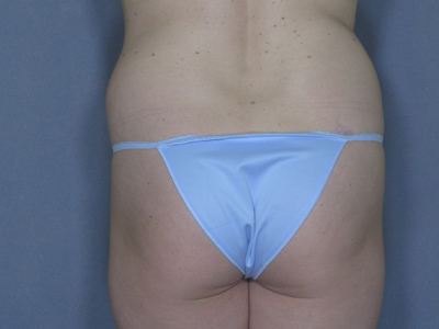 Vaser Liposuction Before & After Patient #778
