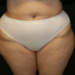 Liposuction Before & After Patient #802