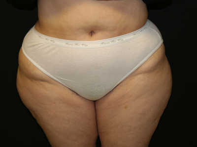 Vaser Liposuction Before & After Patient #802
