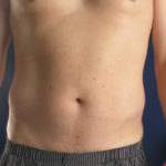 Male Liposuction Before & After Patient #911