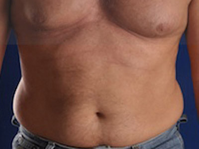 Male Liposuction Before & After Patient #914