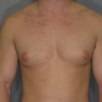 Male Liposuction Before & After Patient #922