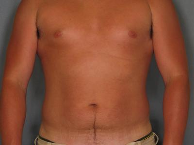 Male Liposuction Before & After Patient #932