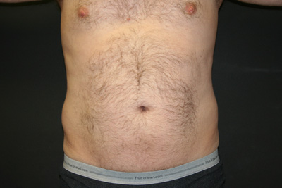 Male Liposuction Before & After Patient #940