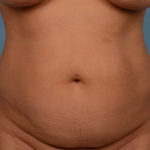 Mini Tummy Tuck Before & After Patient #948