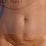 Mini Tummy Tuck Before & After Patient #959