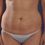 Mini Tummy Tuck Before & After Patient #967