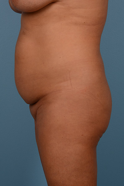 Brazilian Butt Lift (BBL) Before & After Patient #543