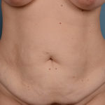 Tummy Tuck Before & After Patient #1219