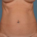 Tummy Tuck Before & After Patient #1241