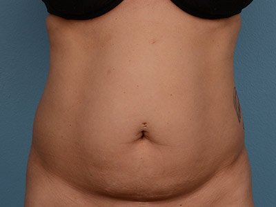 Tummy Tuck Before & After Patient #1252