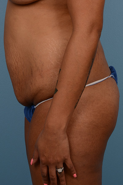 Brazilian Butt Lift (BBL) Before & After Patient #581