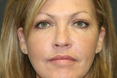 Fillers Before & After Patient #1605