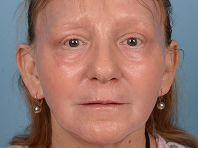 Phenol Peel Before & After Patient #1788