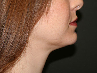 Face & Neck Liposuction Before & After Patient #1953
