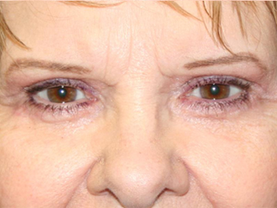 Eyelid Surgery Before & After Patient #2137