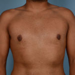 Gynecomastia Before & After Patient #2352