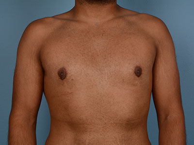 Gynecomastia Before & After Patient #2352