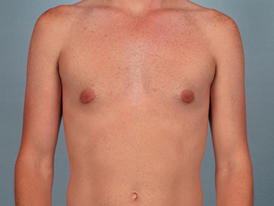 Gynecomastia Before & After Patient #2577