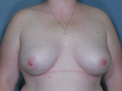 Congenital Breast Deformity Before & After Patient #2676