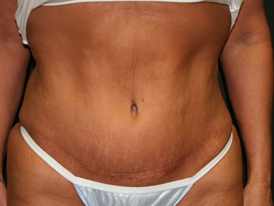 Tummy Tuck Before & After Patient #1597