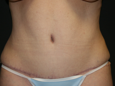 Tummy Tuck Before & After Patient #1613