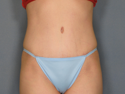 Tummy Tuck Before & After Patient #1623