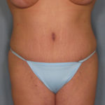 Tummy Tuck Before & After Patient #1638