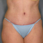 Tummy Tuck Before & After Patient #1645