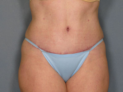 Tummy Tuck Before & After Patient #1645