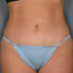 Tummy Tuck Before & After Patient #1651